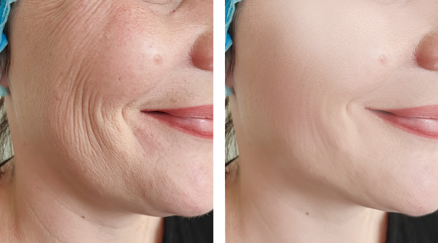 Ozempic Face: Top Dermatologist Shares Expert Tips to Combat GLP-1 Skin Changes